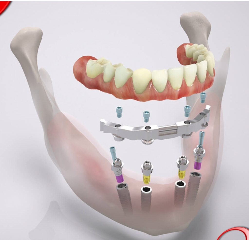 Branemark Implant Catalog – Downloads — P-I Brånemark – QDVKH